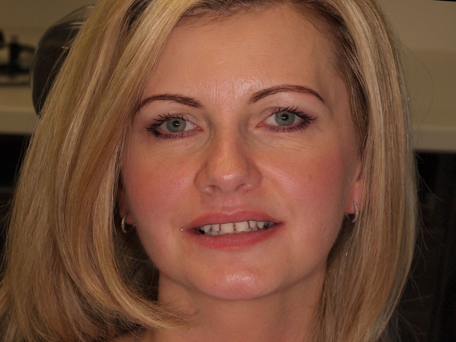 Veneers Gallery Before & After