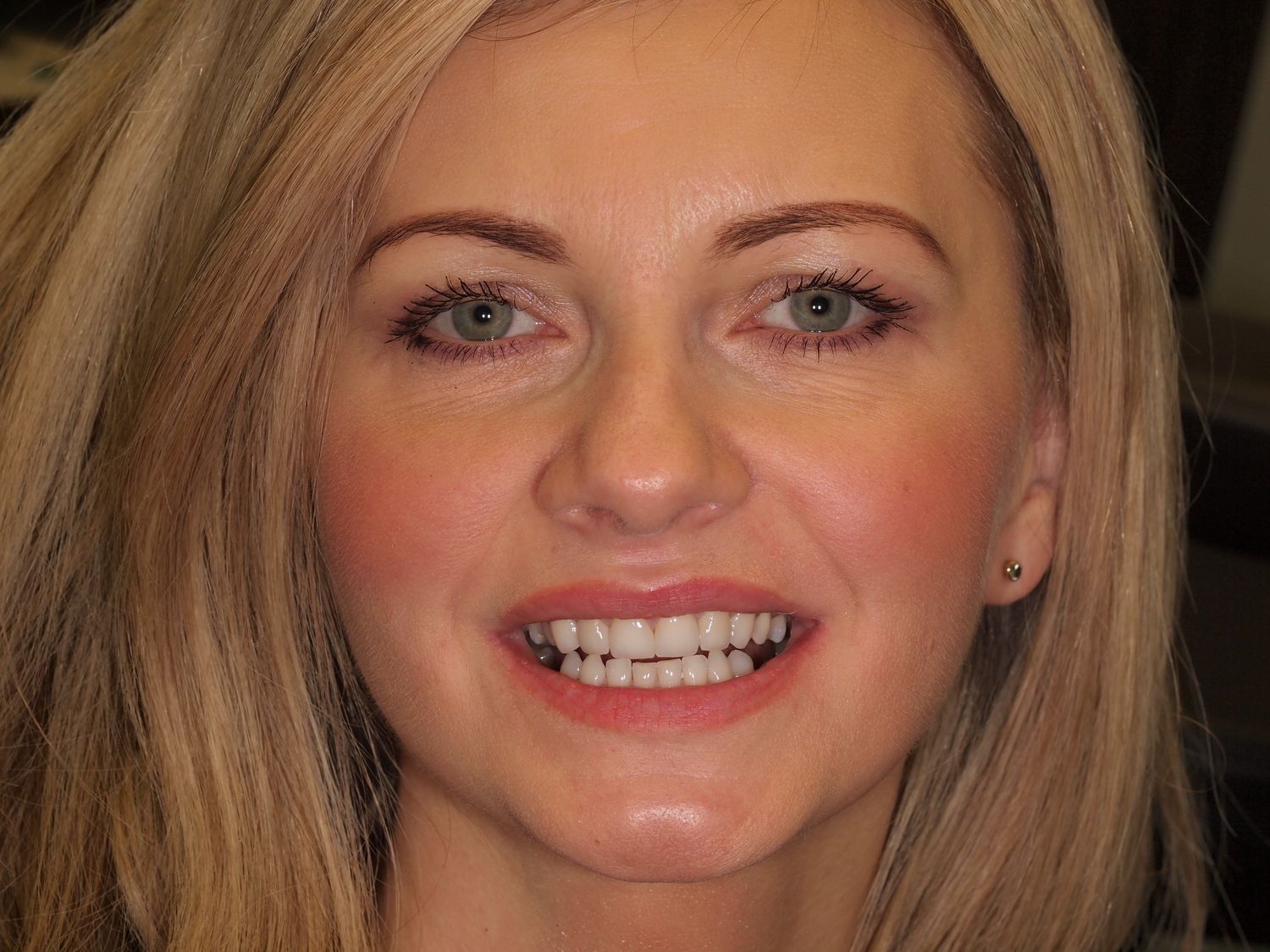 Veneers Gallery Before & After