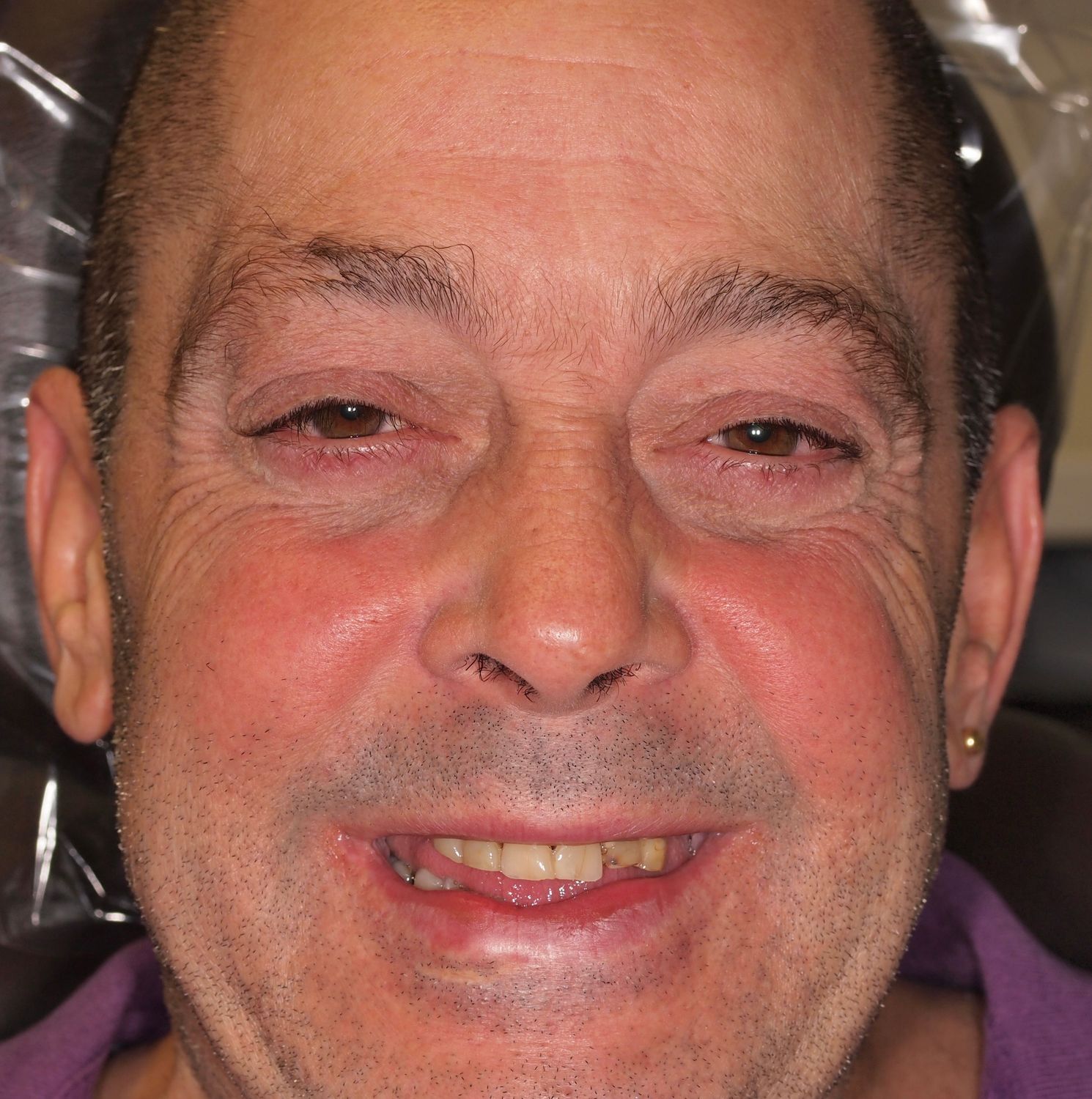 Veneers Gallery Before & After