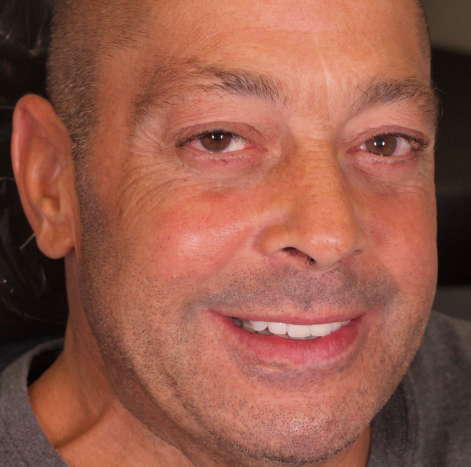 Veneers Gallery Before & After