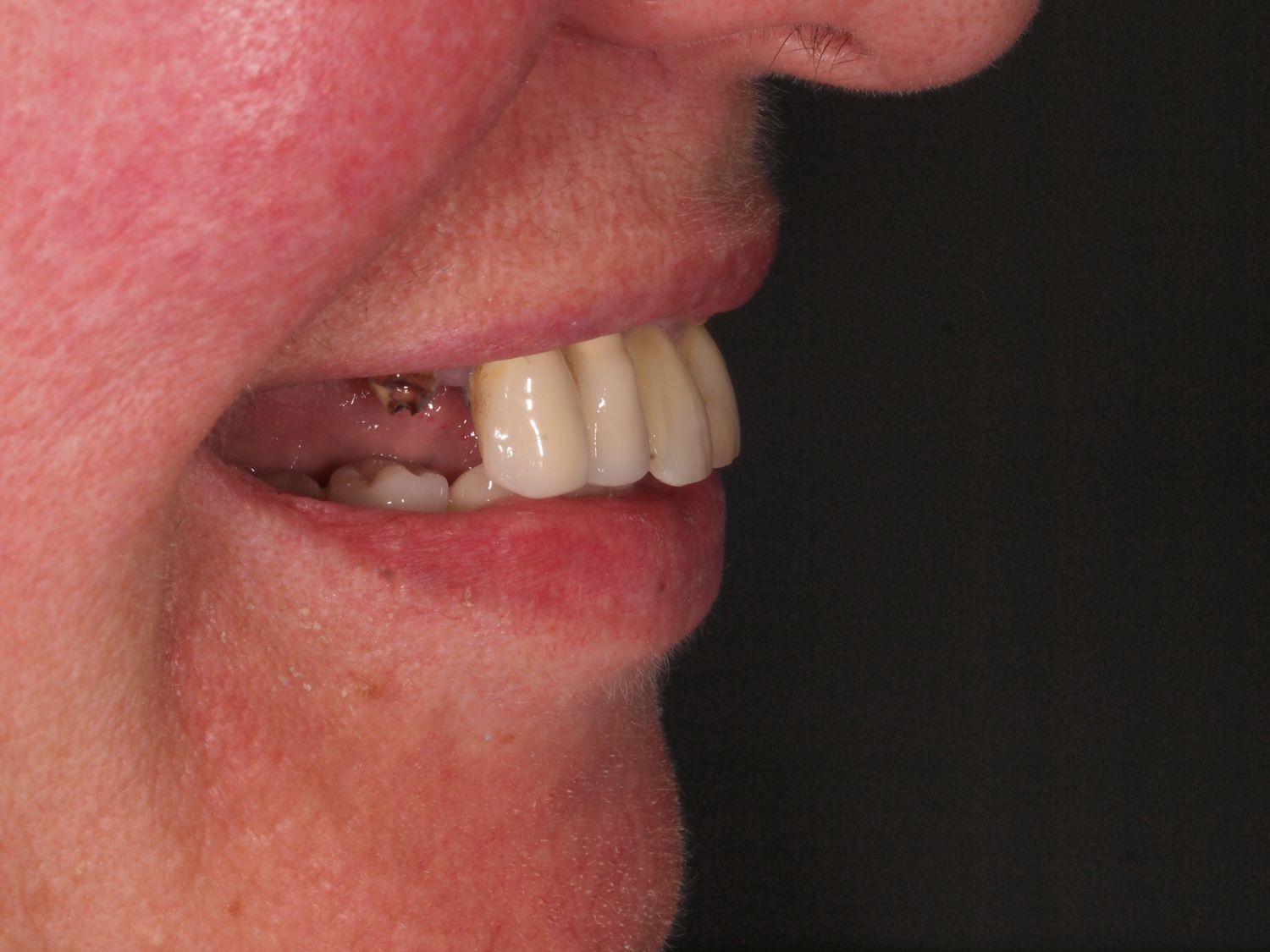 Full Mouth Veneers Before & After