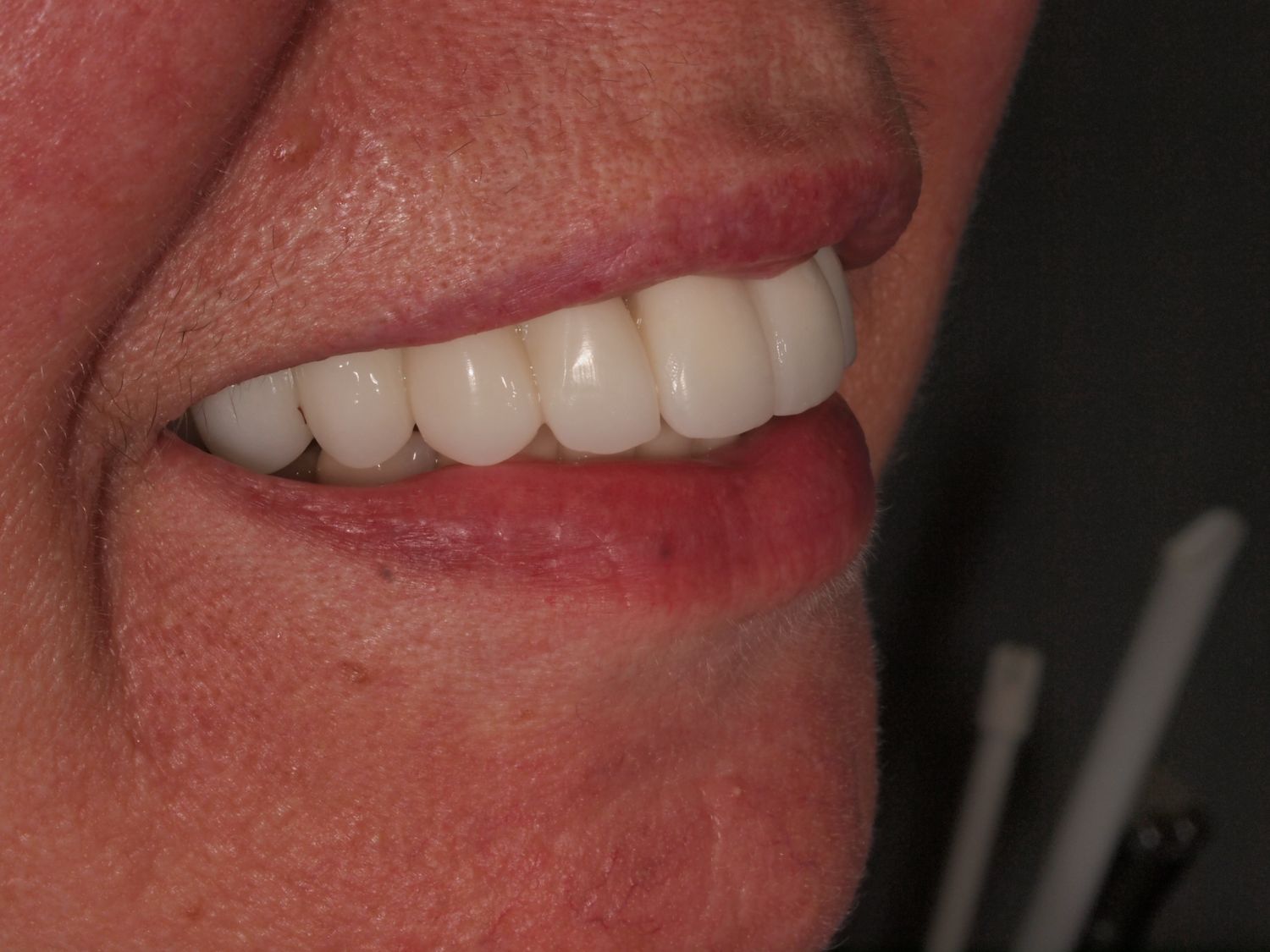 Full Mouth Veneers Before & After