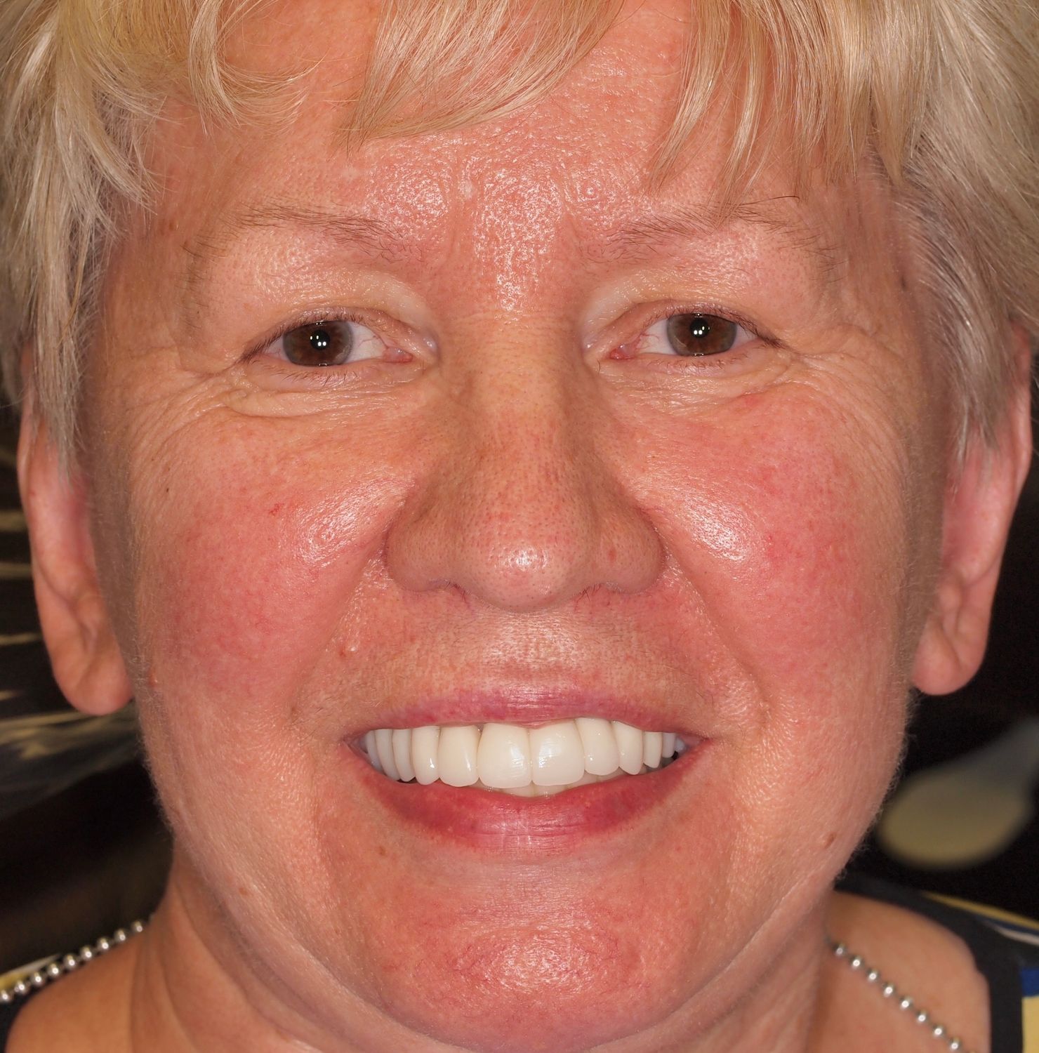 Full Mouth Veneers Before & After