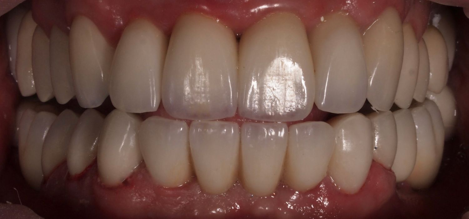 Full Mouth Veneers Before & After
