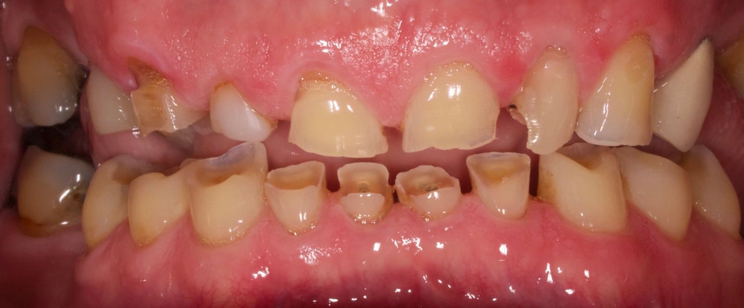 Full Mouth Veneers Before & After